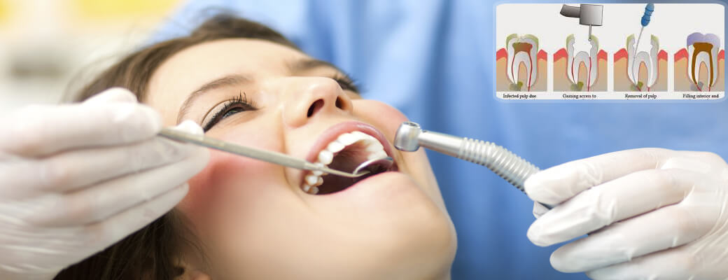 Root Canal